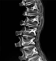 Визначити наявність стенозу хребтового каналу за допомогою рентгену хребетного відділу